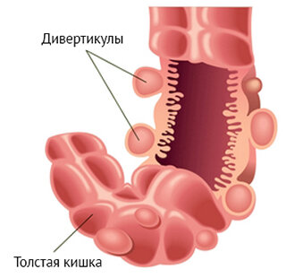 Дивертикулез кишечника мкб 10
