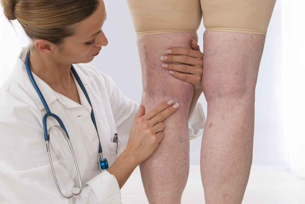 4 тревожные признаки, которые указывают на появление тромбов в ногах
