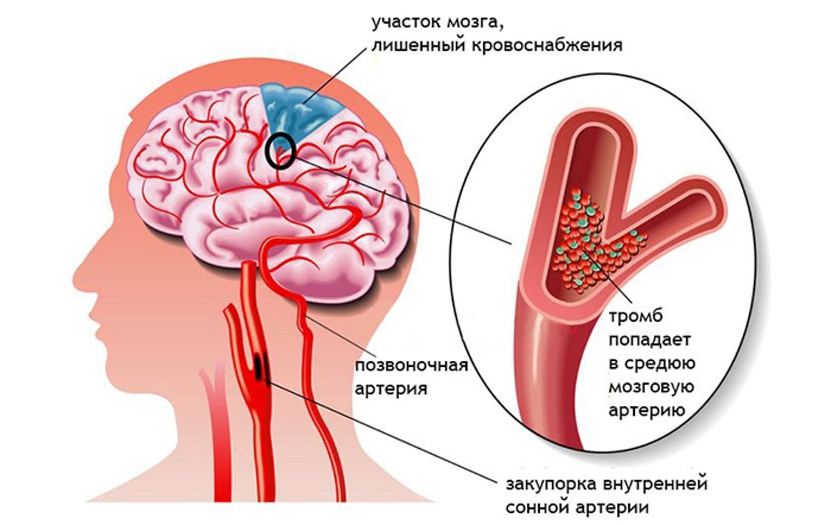 Инсульт и его первые признаки.