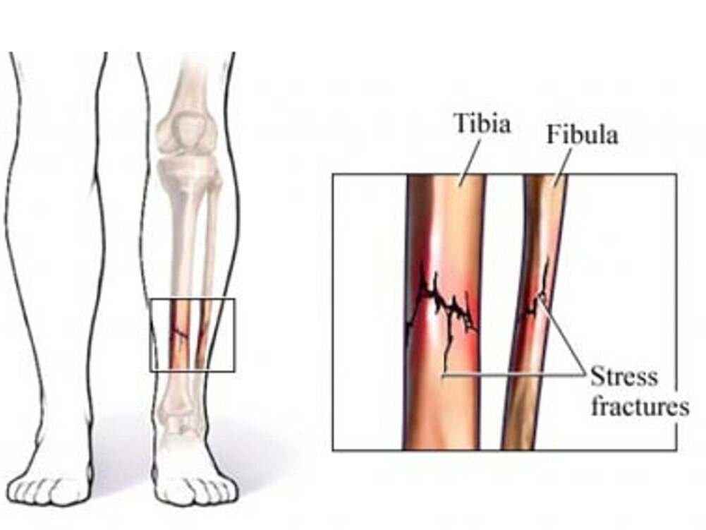 Перелом берцовой кости. Стрессовый перелом большеберцовой кости симптомы. Стресс перелом большеберцовой кости. Осколочный перелом малой берцовой кости. Перелом голени, малая берцовая кость.
