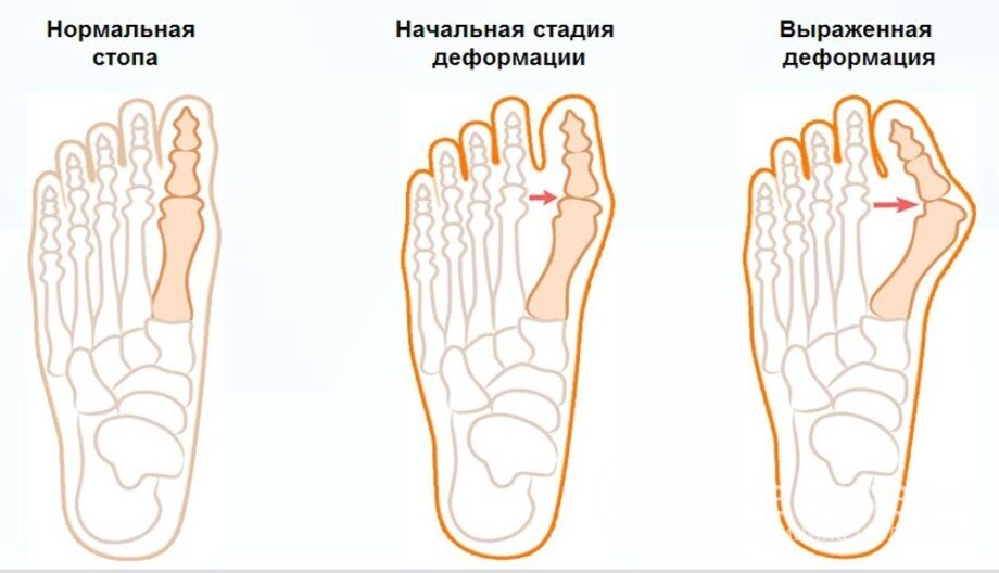 К таким (и не только) последствиям  может привести обувь неправильного размера