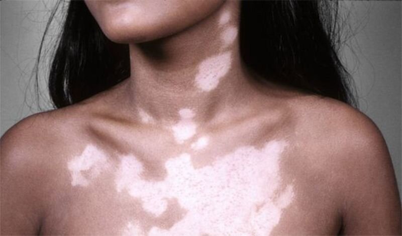 Какие болезни вызывают пятна на коже?