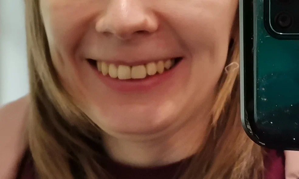 Передний зуб - имплант. Заметно?