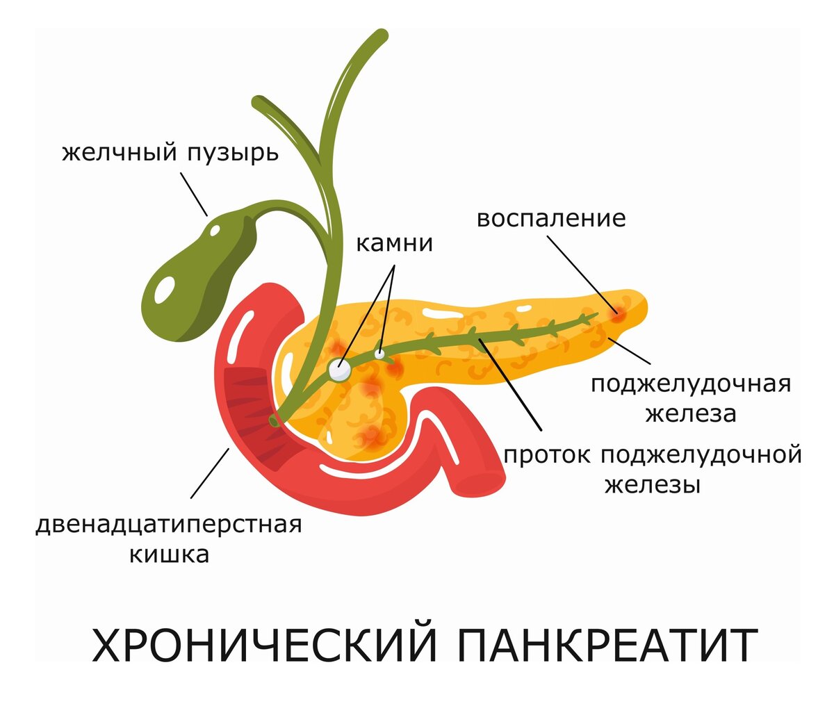 Хронический панкреатит: симптомы, причины, осложнения, диагностика в СПб