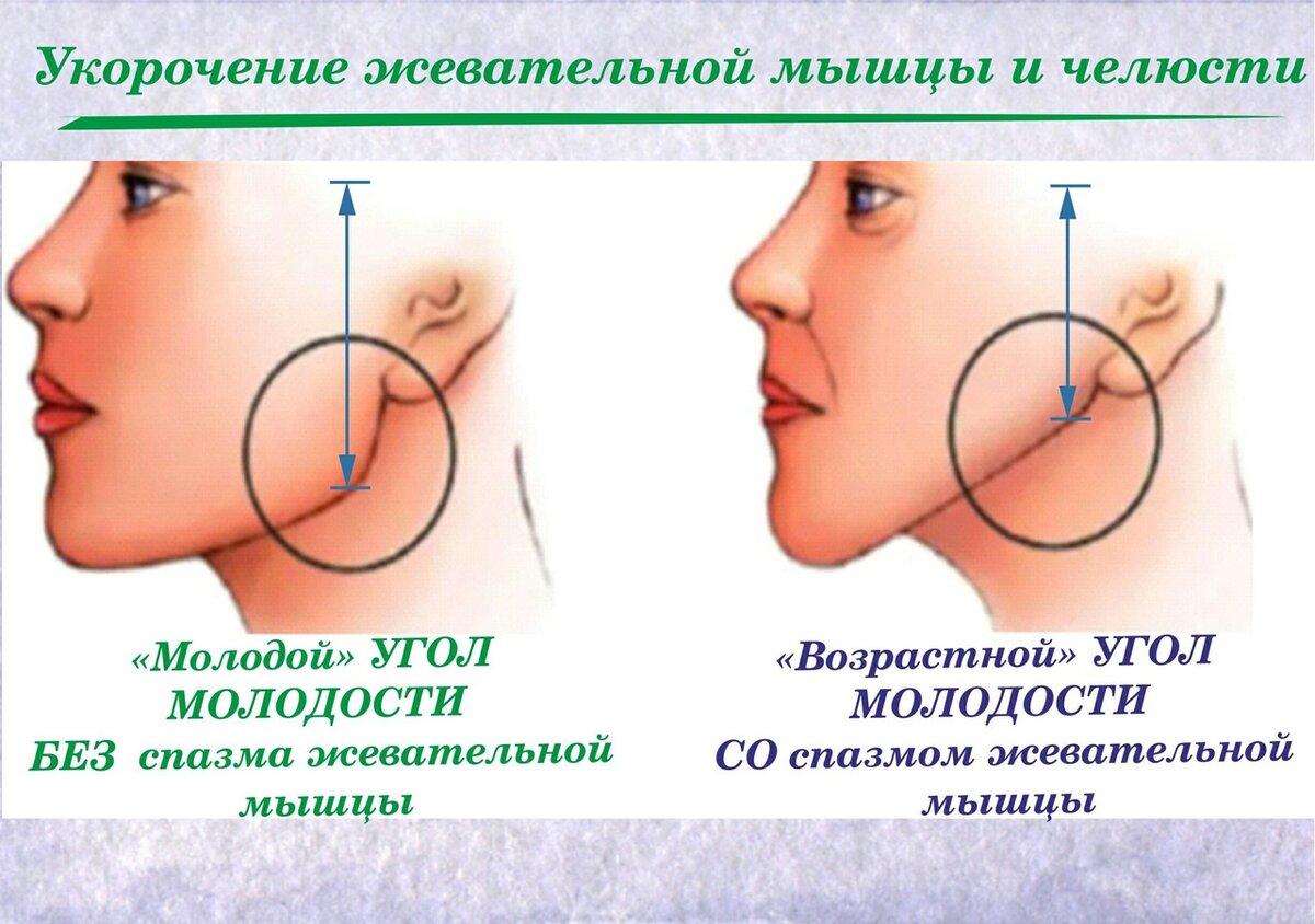 Лечение боли в жевательных мышцах