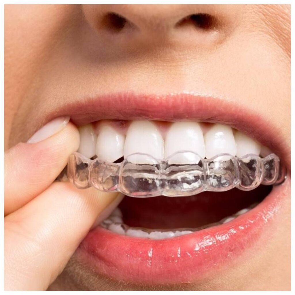    Выравнивание зубов при помощи элайнеров — прекрасная возможность избавиться от дефектов прикуса