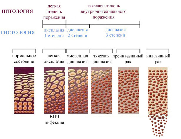 Схема лечения дисплазии шейки матки 1 степени