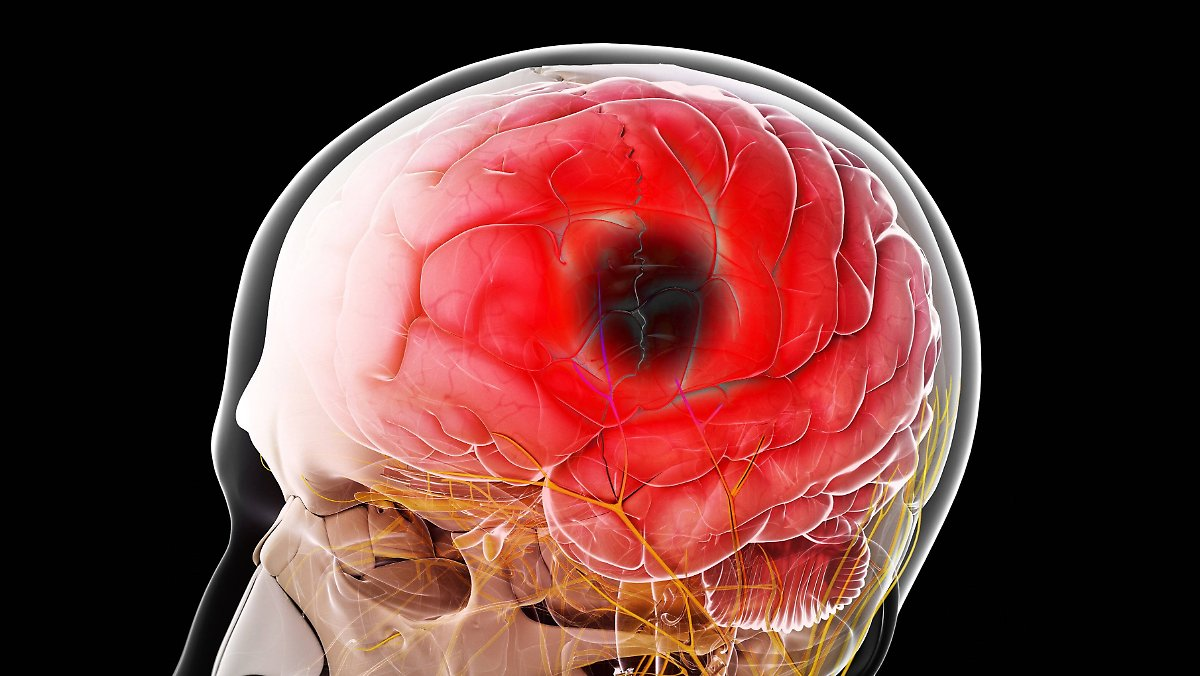 Диагноз ХИГМ: что такое ишемия головного мозга и почему она бывает опасной?  | О здоровье: с медицинского на русский | Дзен