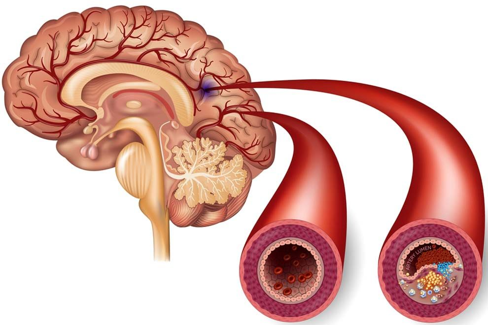 Облитерирующий атеросклероз артерий нижних конечностей: причины, симптомы и лечение