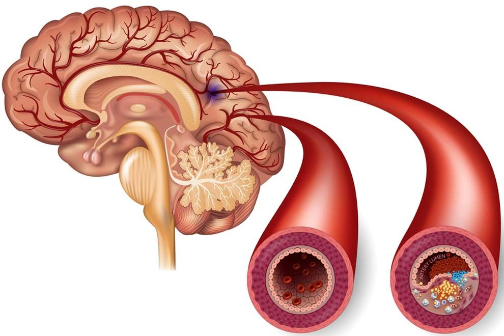 Болезни головных сосудов. Атеросклероз артерий головного мозга. Атеросклероз церебральных сосудов. Атеросклероз церебральных сосудов симптомы. Атеросклероз сосудов мозга.