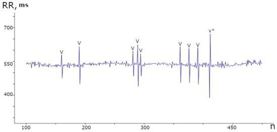 Кардиоспайки на ритмограмме выглядят как резкие вертикальные линии. Источник: Сергей Стасенко. 