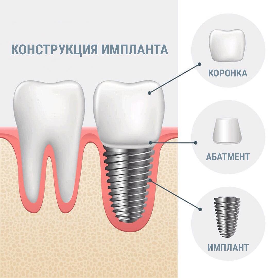 Сколько лет стоят импланты. Имплант зуба абатмент. Структура дентального имплантата. Зубной имплант строение. Строение дентального импланта.