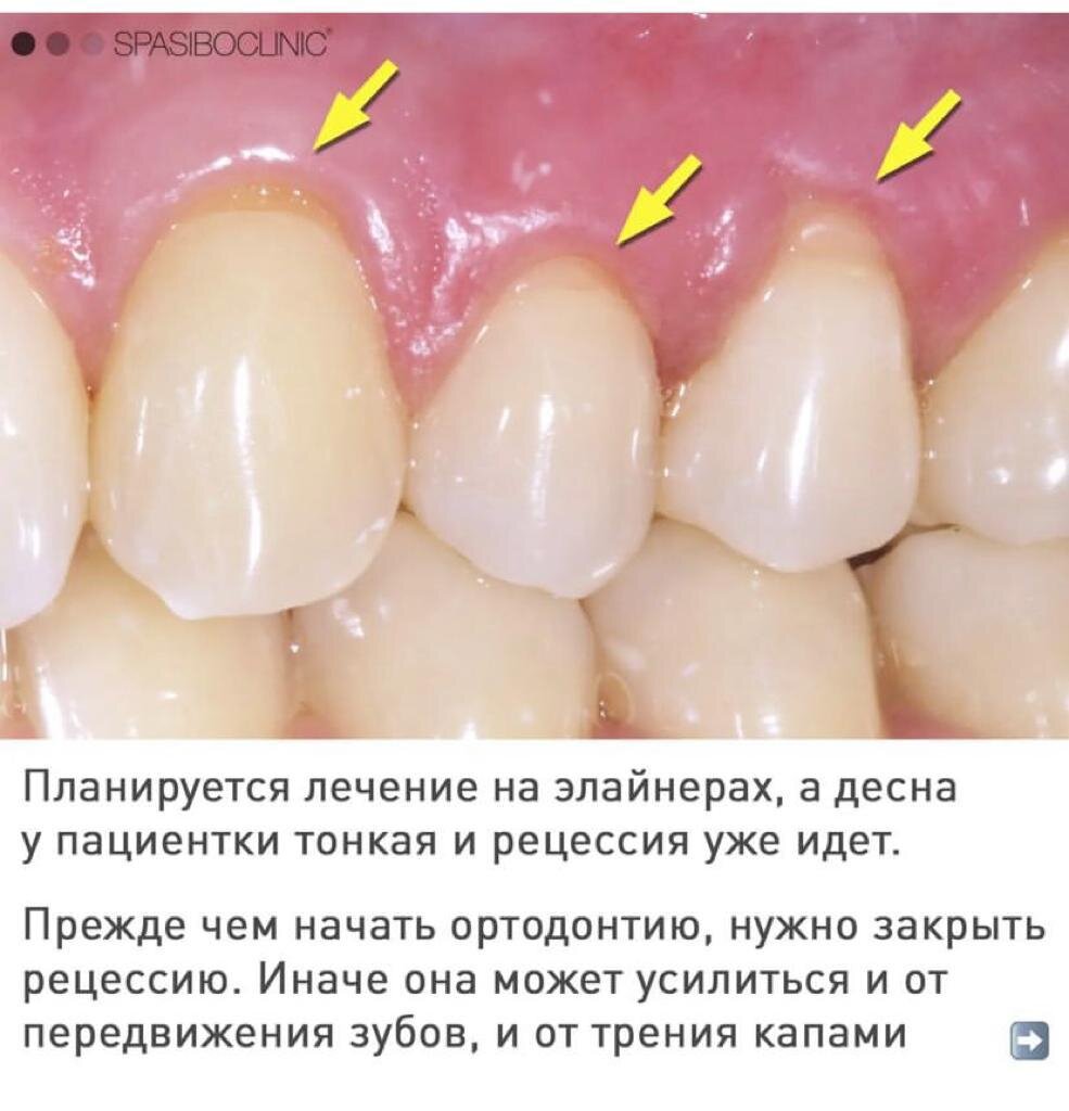 ПЛАСТИКА ДЕСНЫ - ЭТО НЕ СТРАШНО 🤓 | Спасибо.Клиник | Дзен