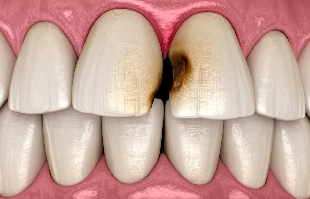 Гнилые зубы: чем опасны и как лечить? | Цифровая стоматология Денталь в  Москве | Дзен