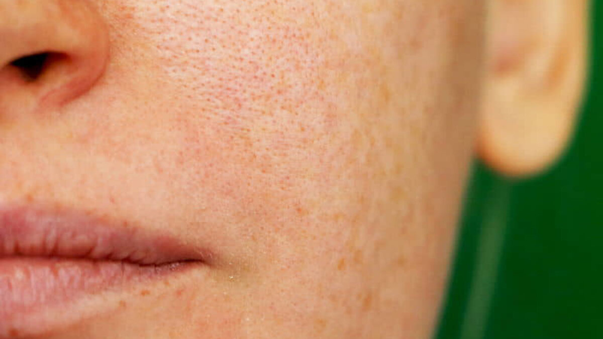 Расширенные поры