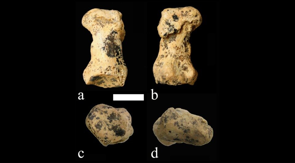   Silvana Condemi et al. / International Journal of Paleopathology, 2023