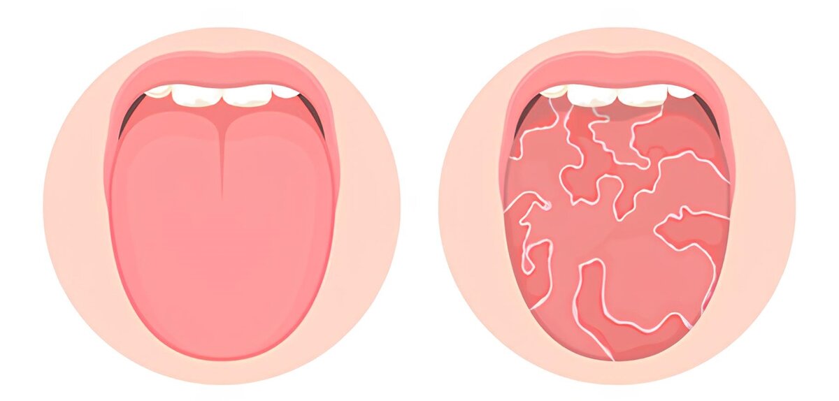Географический язык: причины, симптомы, лечение