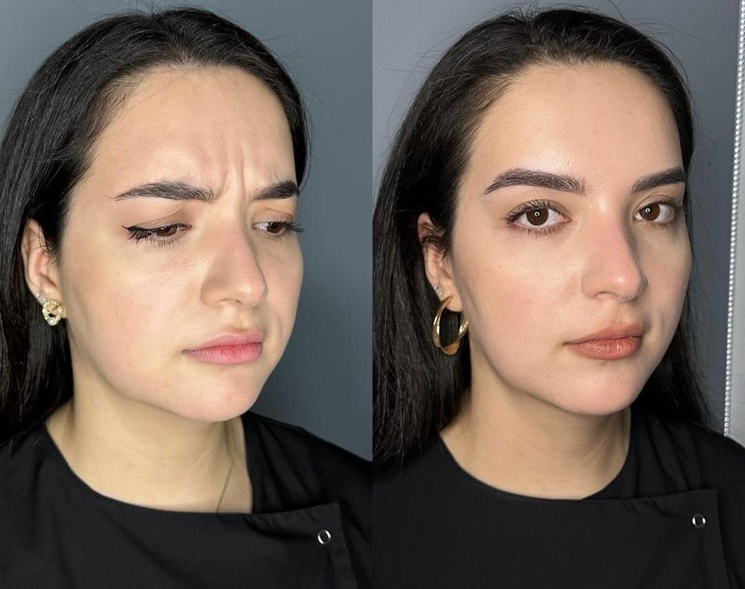 Нахмуривание. Фото слева - до процедуры, фото справа - после процедуры.