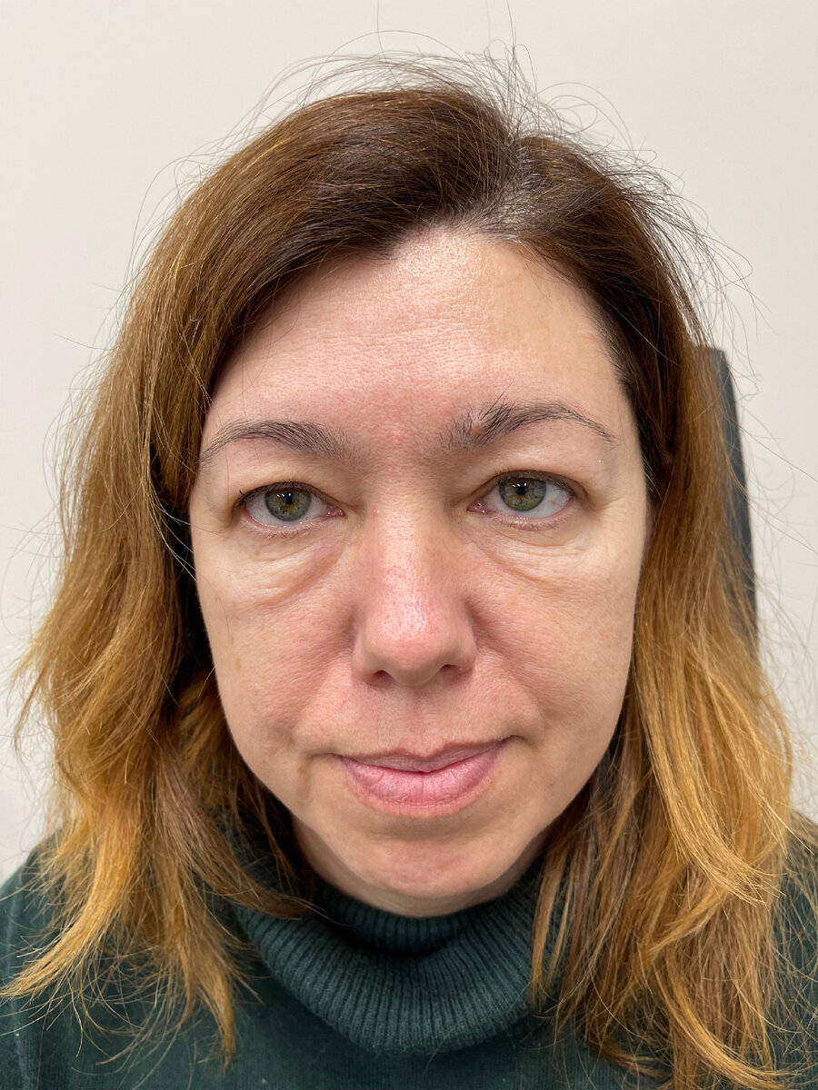 Фото до круговой блефаропластики