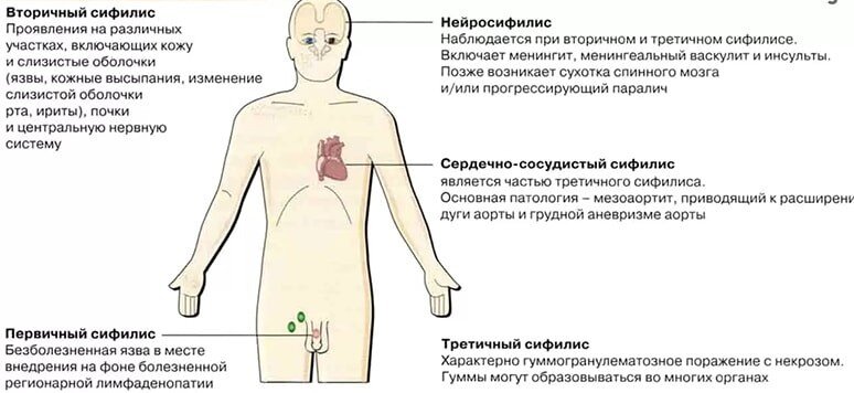 Клинические признаки сифилиса, у Ленина подозревали разновидность с приставкой Нейро