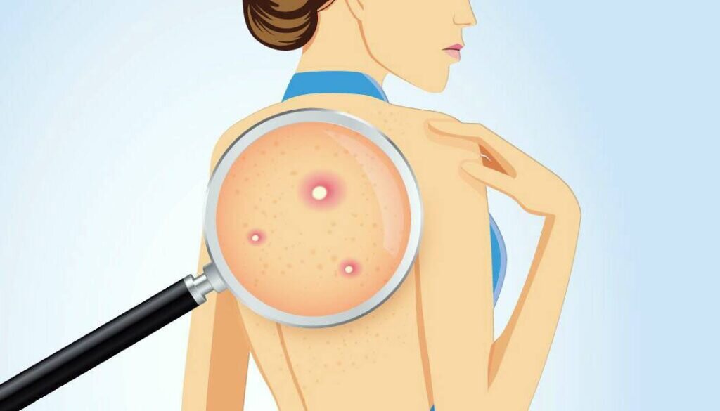 Прыщи на спине: причины и методы лечения