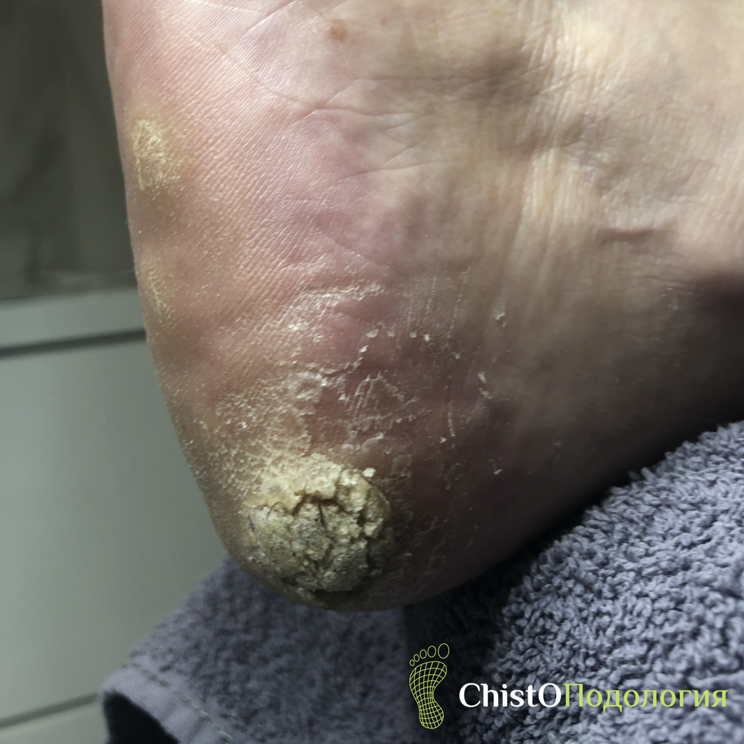 Пример проявления ВПЧ