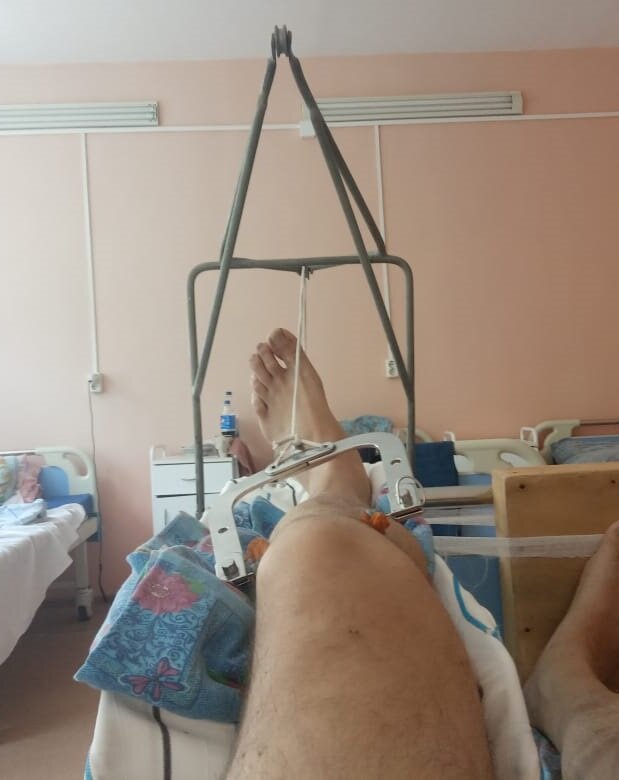 Просверлена берцовая кость ниже колена, туда вставлена изображённая на фото железяка, к которой подвешивают гирю. Верёвку от гири тут видно, а сама гиря висит за спинкой кровати ближе к полу.