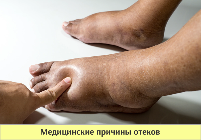 Медицинские причины отеков и задержки жидкости