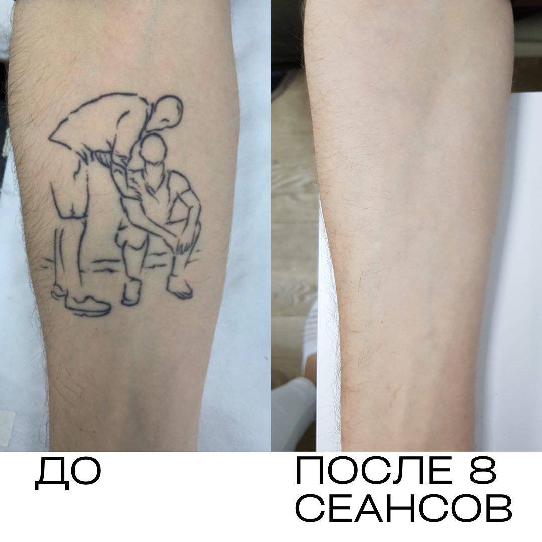 Убрать тату с фото