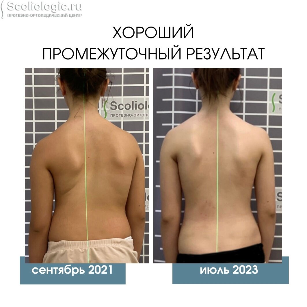 Техника массажа при сколиозе позвоночника - презентация онлайн