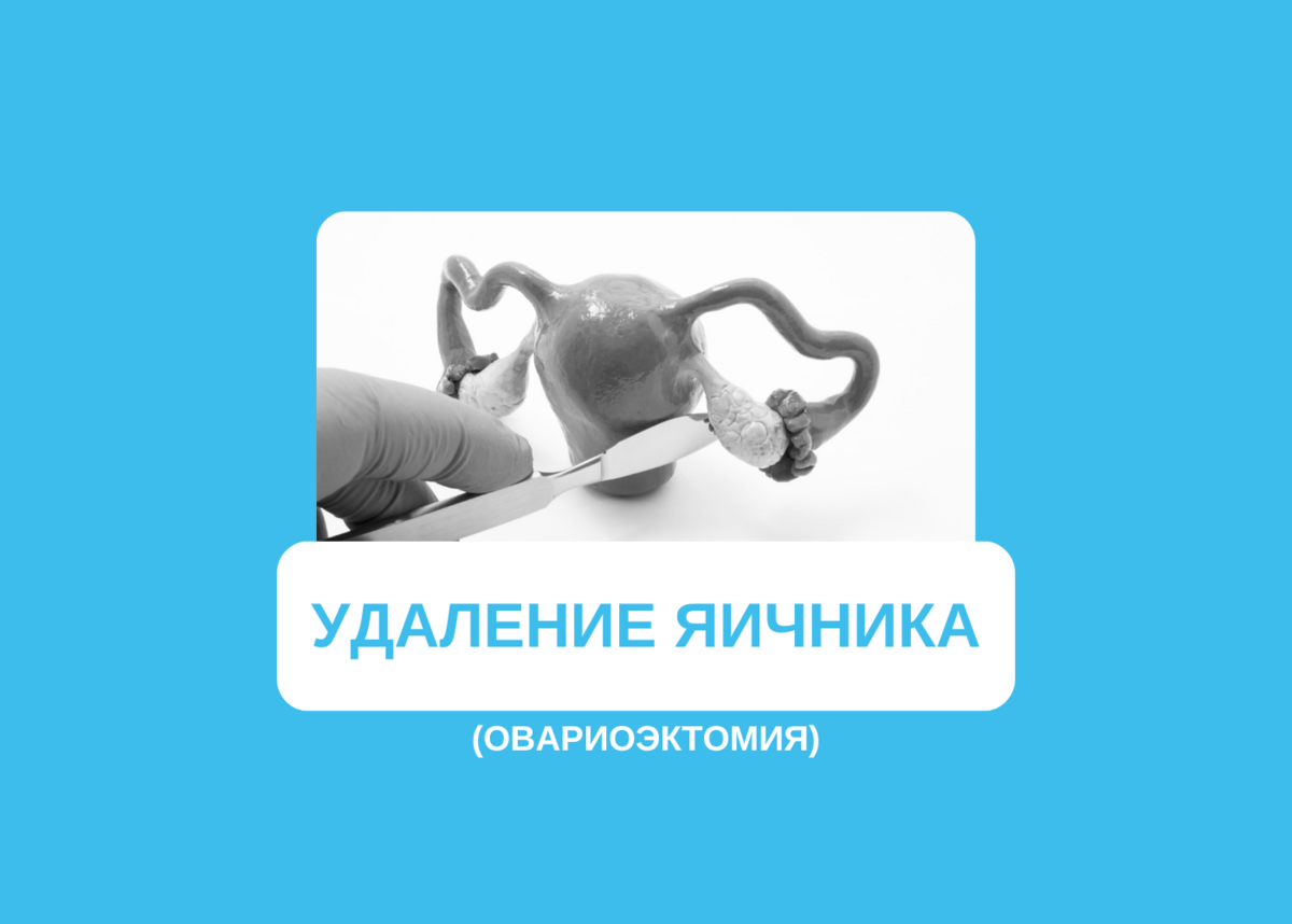 Удаление яичника (овариоэктомия) | Клиника «АльтраВита» | Дзен