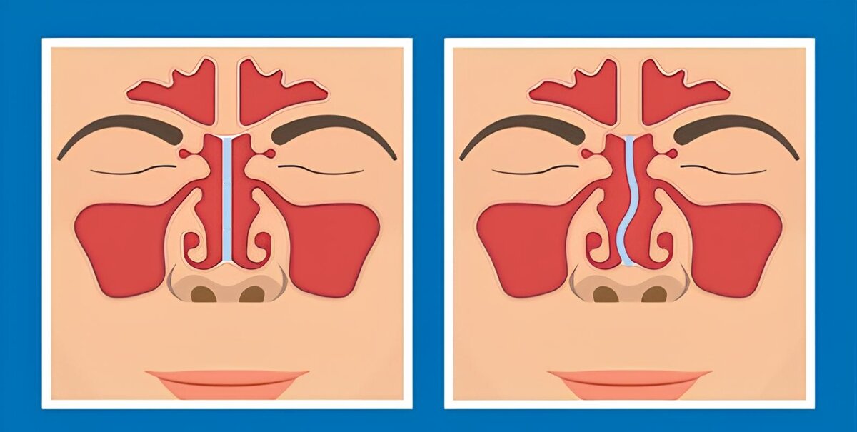 Слева- норма, справа- искривление носовой перегородки