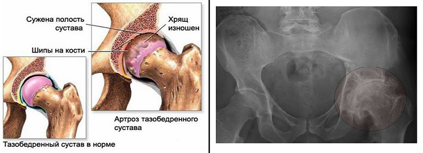 Деформирующий артроз тазобедренного. Артроза тазобедренного сустава коксартроза. Тазобедренный артроз 1 стадия. Коксо артроз бедренного сустава симптомы. Коксалгия тазобедренного сустава