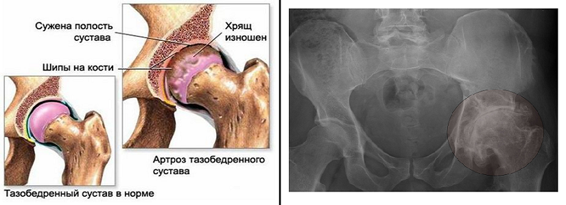 Чем лечить коксартроз 2 степени тазобедренных суставов. Тазобедренный артроз 1 стадия. Коксартроза тазобедренного сустава. Коксартроз тазобедренного сустава 3 4 степени. Рентген коксартроза тазобедренного сустава 3 степени.