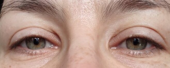 How to Get Rid of a Stye