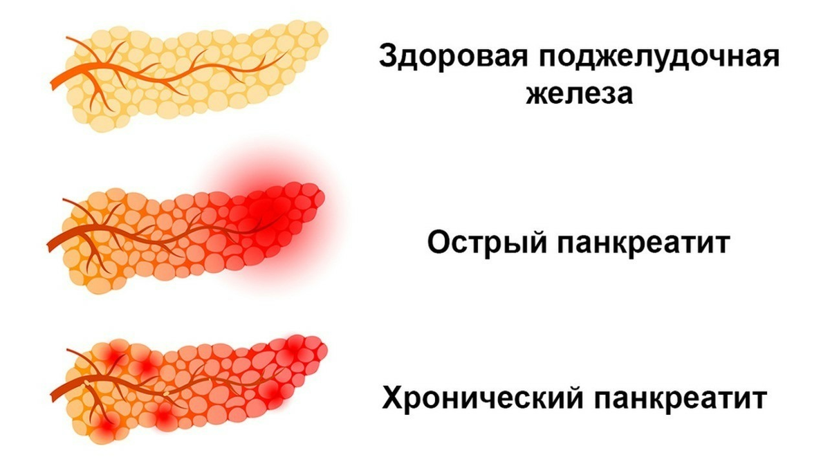 Панкреатит | Фельдшер | Дзен