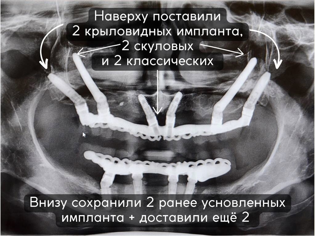 Здесь вы видите комбо из нескольких видов имплантации: одна из них – Зигома. Это по 2 длинных скуловых импланта с каждой стороны. 