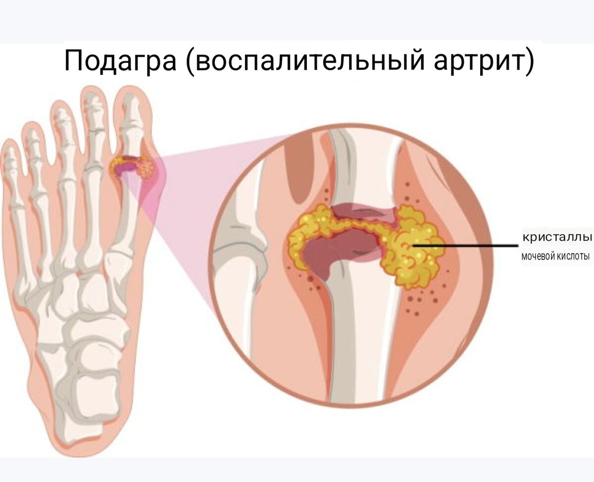 Подагра | Коррекция питания прежде всего! | НОВОСТИ ДОЛГОЛЕТИЯ ...