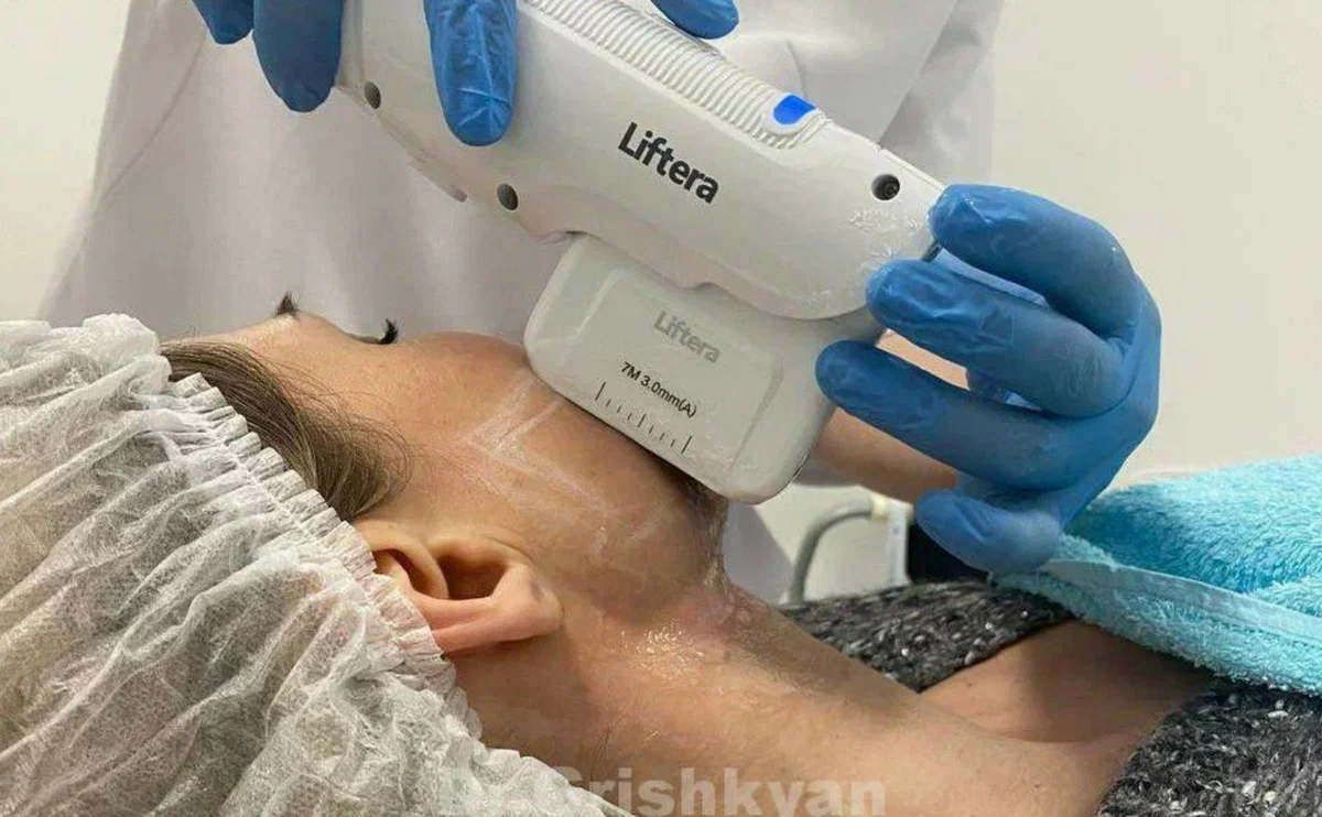 СМАС-лифтинг на аппарате Liftera. Фото предоставлено Д.Р. Гришкяном. Имеются противопоказания, требуется консультация специалиста