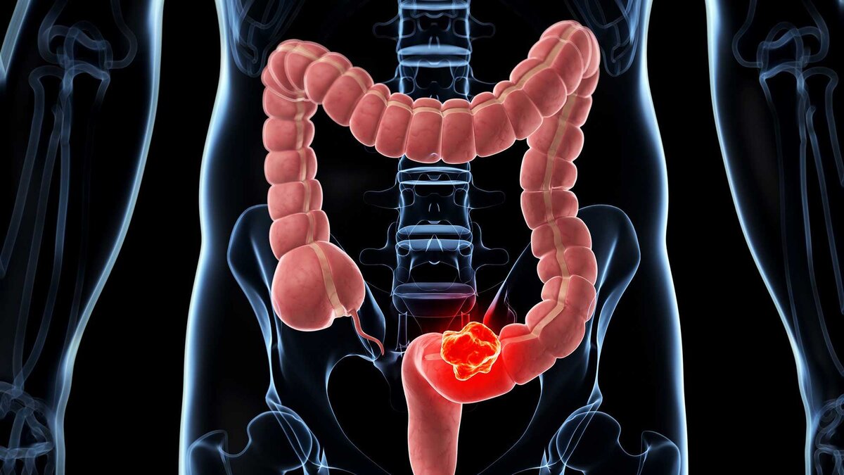 Колоректальный рак: профилактика, стадии и симптомы в клинике Hadassah
