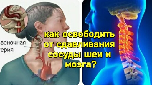 Шея и мозг еле дышат, страдают от дефицита крови? Освободите позвоночные артерии от компрессии