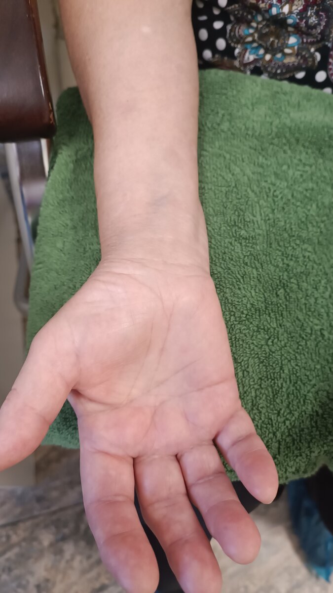 Обратите внимание, область в основании большого пальца как бы провалена вниз. 