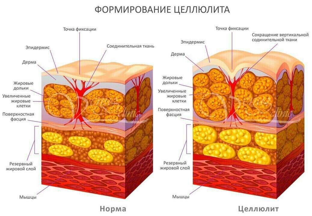 Целлюлит: профилактика и комплексное лечение «апельсиновой корки»