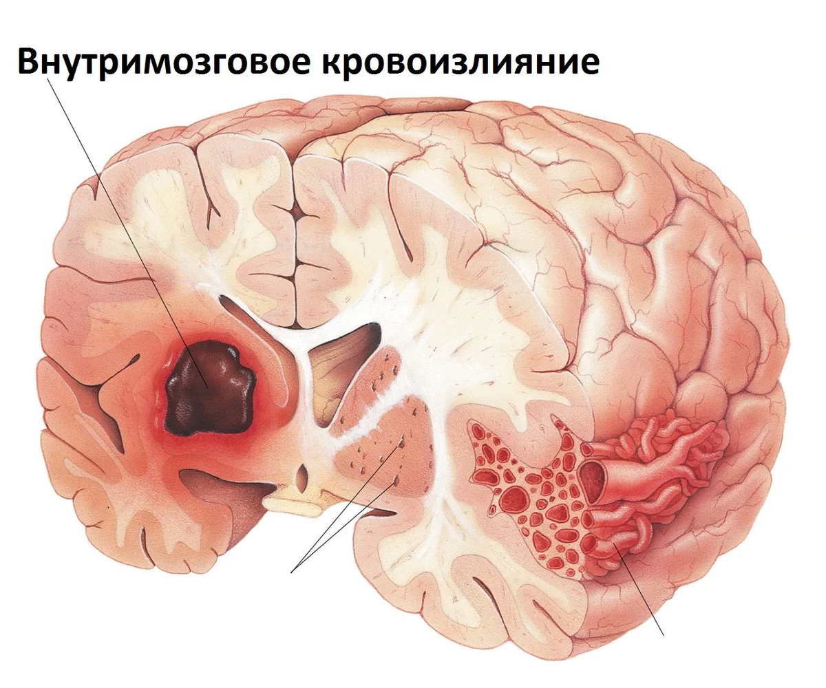 Геморрагический инсульт картинки