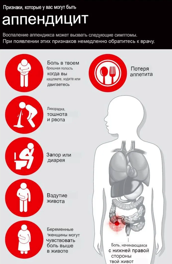 Симптомы и признаки аппендицита, лечение