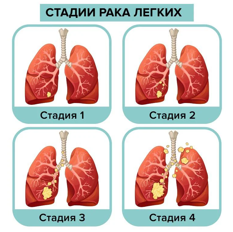 Как выглядит первая стадия рака