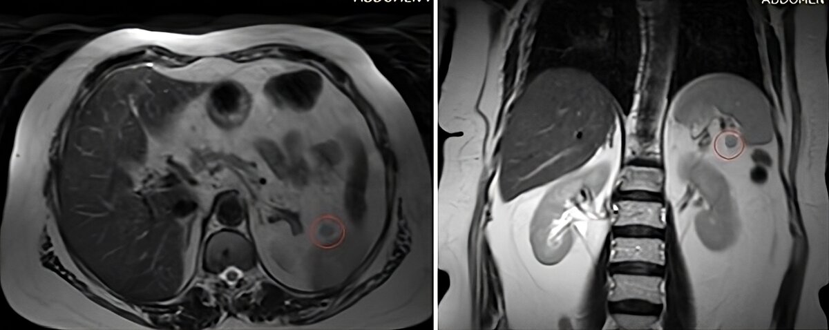 Добавочная селезенка кт. Добавочная долька селезенки мрт. Добавочная селезенка кт. Добавочная селезенка кт. Добавочная селезенка кт.