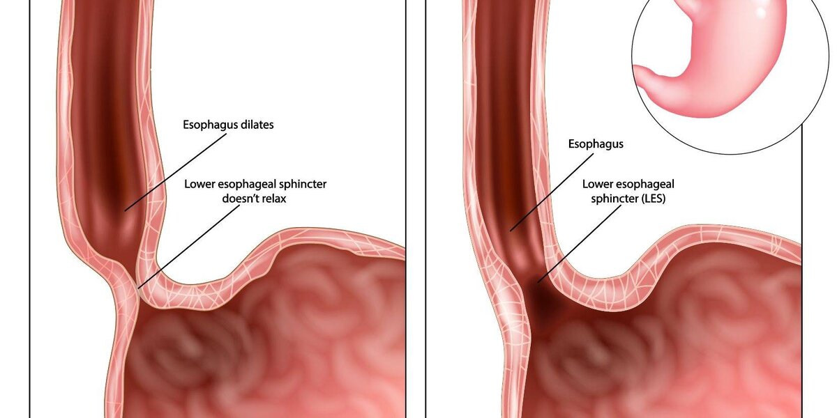 Рисунок справа - норма (желудочно -пищеводный переход сомкнут). Рисунок слева - Халазия кардии (переход зияет из-за нарушений нервной регуляции кардиального сфинктера). 
