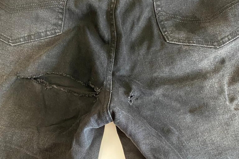    Такие дыры неизвестное вещество прожгло на джинсах пострадавшей читатель URA.RU