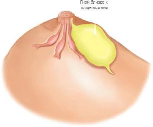 Лечение кисты молочной железы